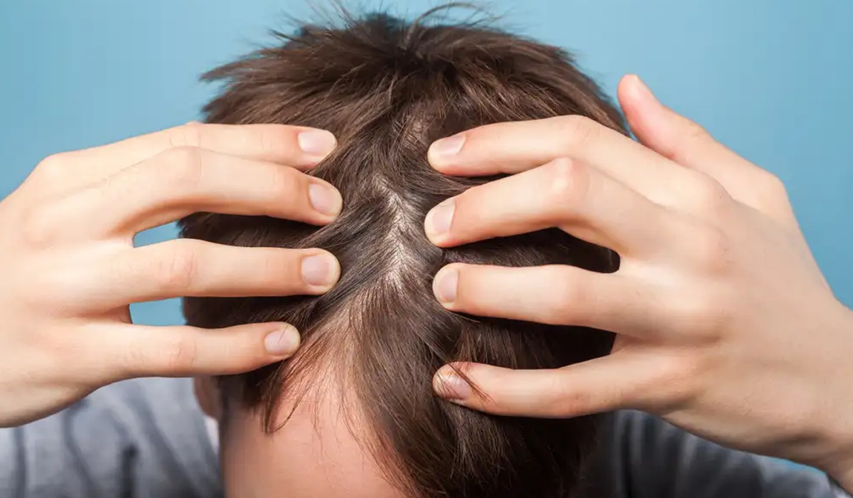 Picazón después de un Trasplante de Cabello