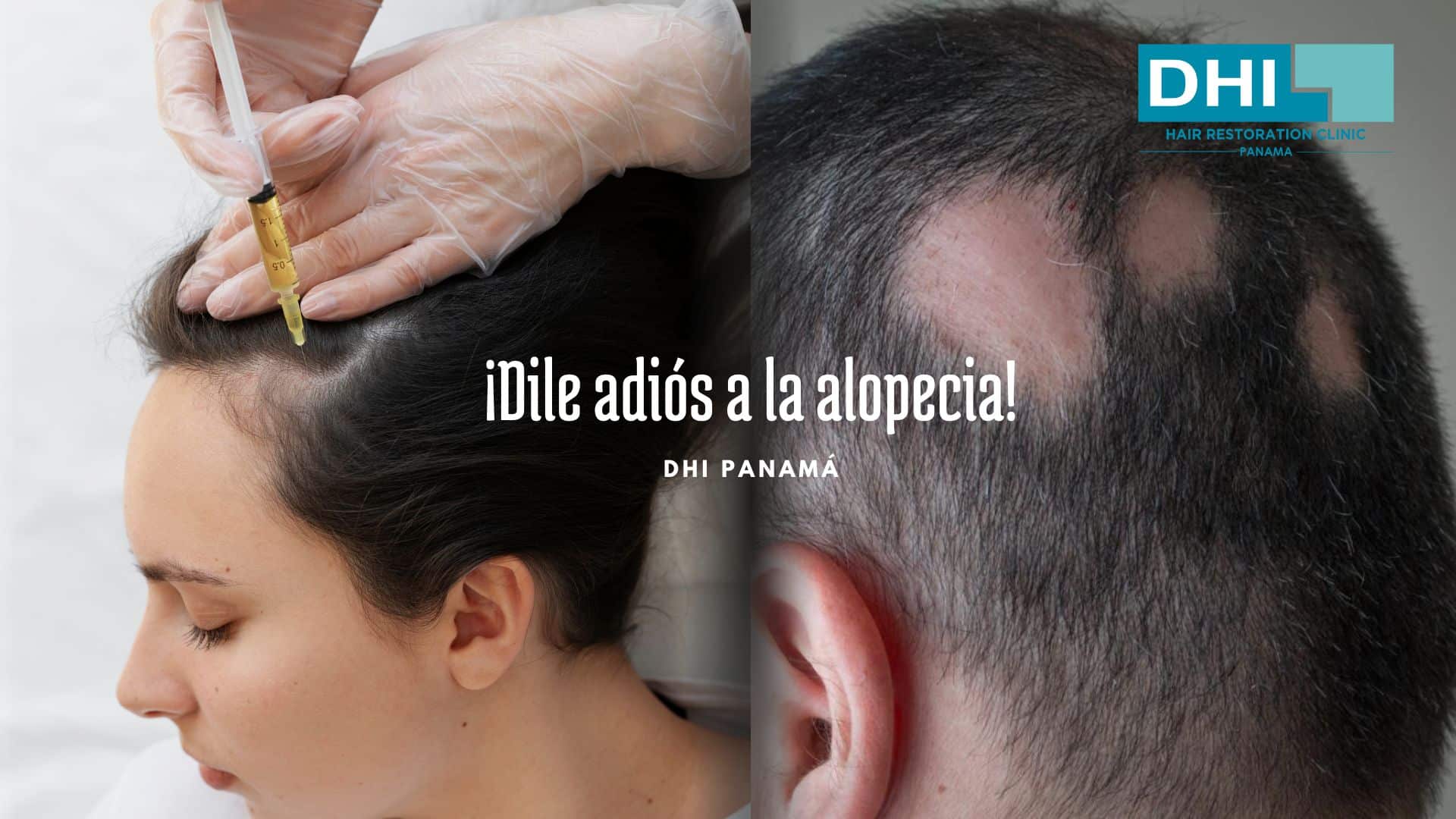 Tratamientos Modernos para la Alopecia